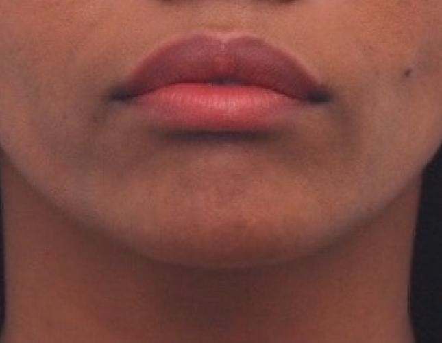 Chin Asymmetry after