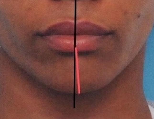 Chin Asymmetry before