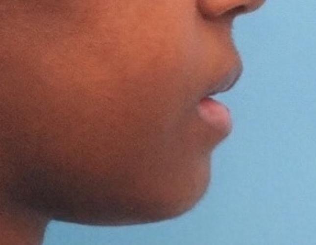 Chin Advancement 10 after