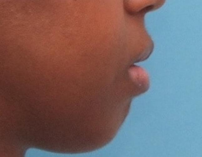 Chin Advancement 10 before