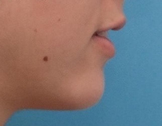 Chin Advancement 11 after