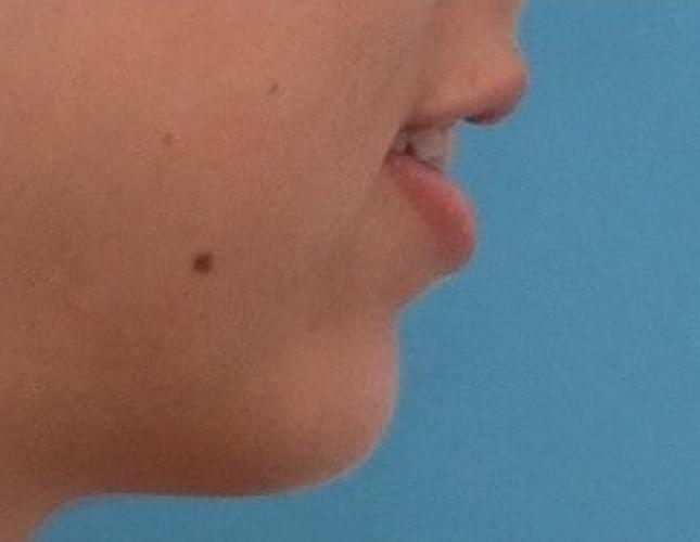 Chin Advancement 11 before