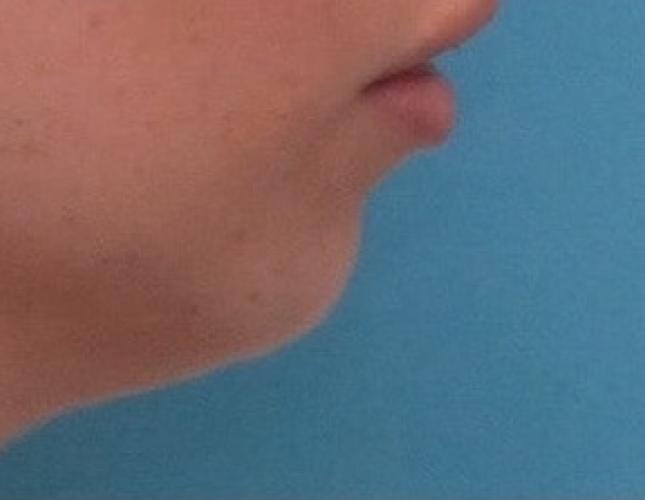 Sliding Genioplasty 1 before