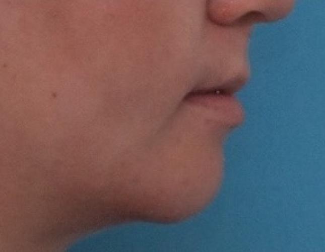 Sliding Genioplasty 2 after