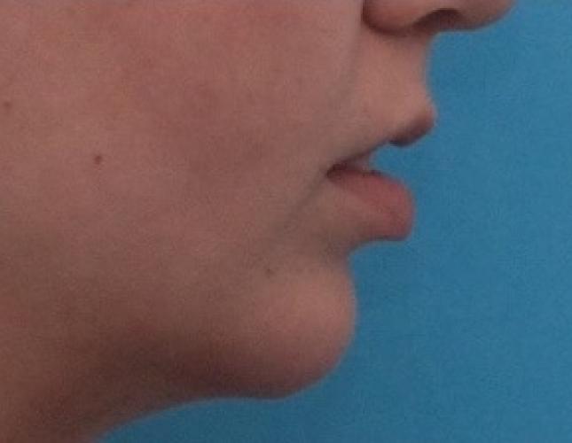 Sliding Genioplasty 2 before