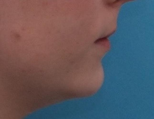 Sliding Genioplasty 3 after