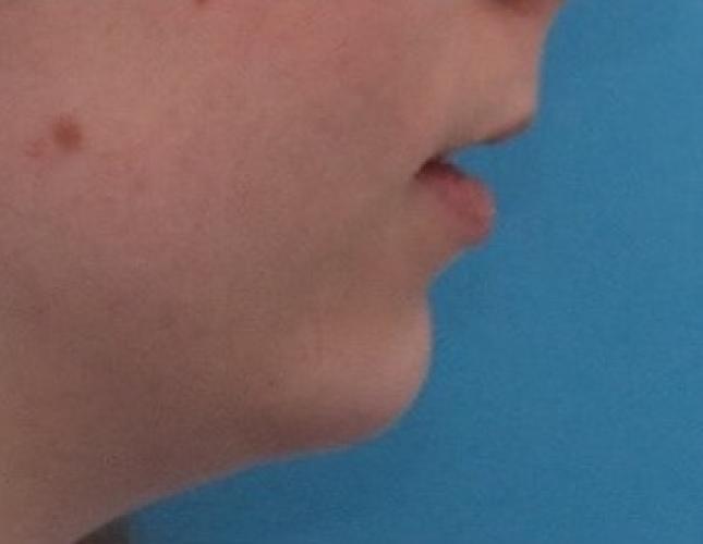 Sliding Genioplasty 3 before