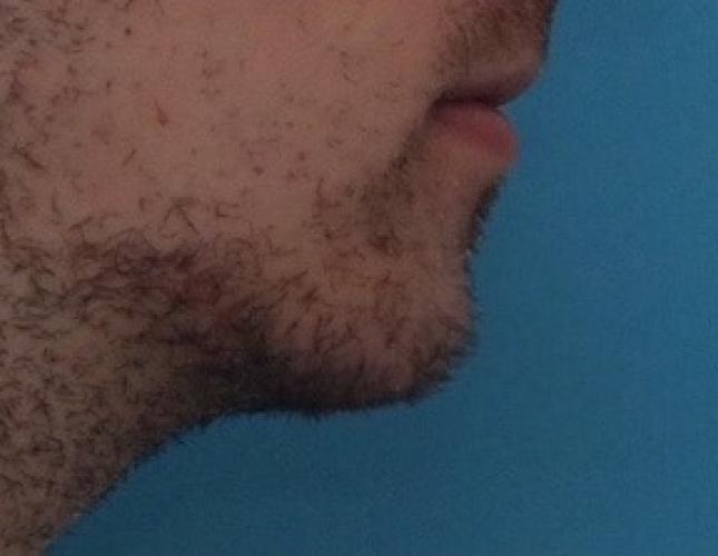 Sliding Genioplasty 4 after