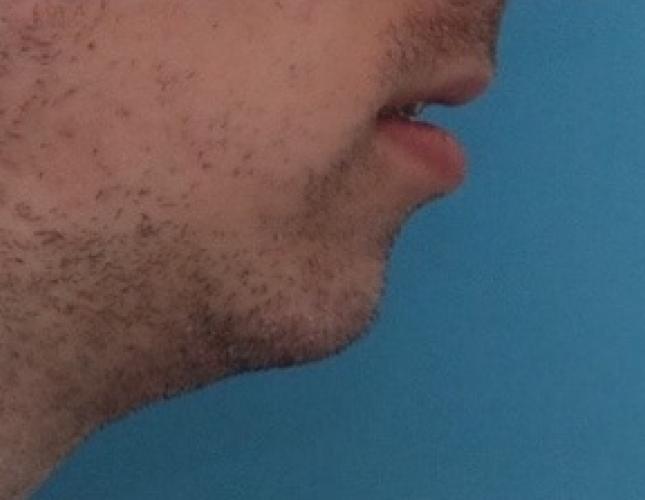 Sliding Genioplasty 4 before