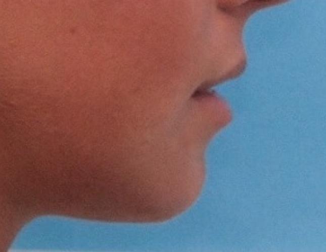 Sliding Genioplasty 5 after