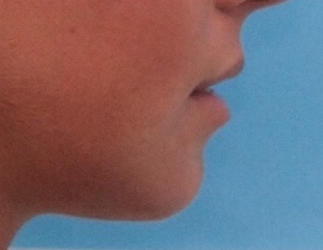 Sliding Genioplasty 5 after