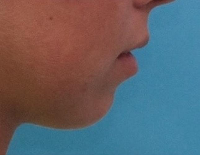 Sliding Genioplasty 5 before