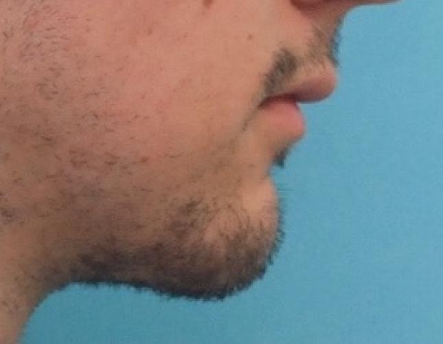 Sliding Genioplasty 6 after