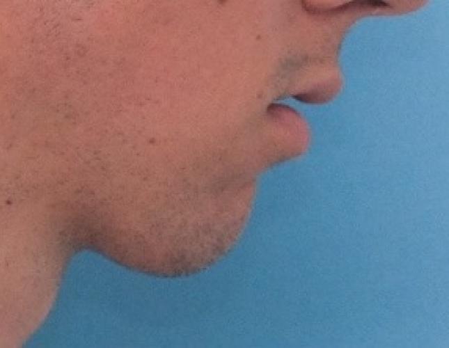 Sliding Genioplasty 6 before