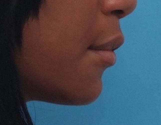 Sliding Genioplasty 7 after