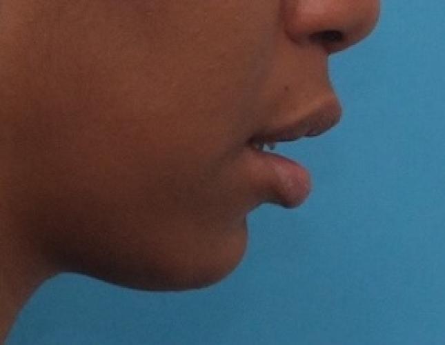 Sliding Genioplasty 7 before