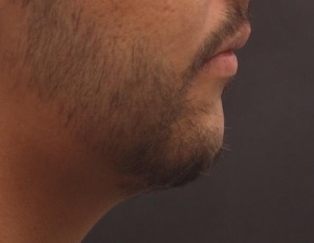 Chin Advancement 8 after