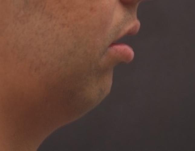 Chin Advancement 8 before
