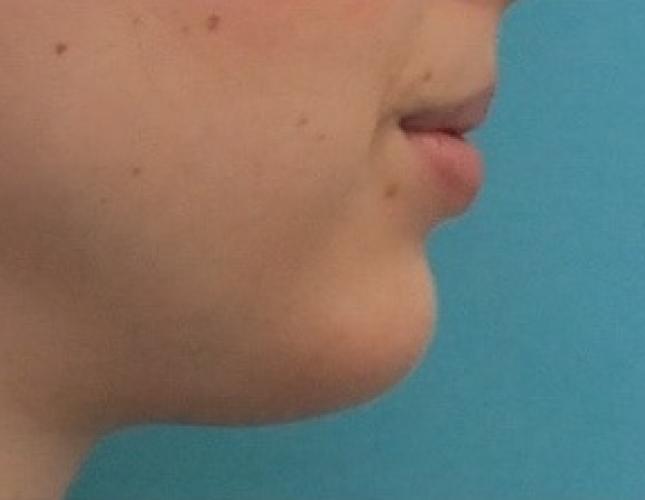 Sliding Genioplasty 9 after