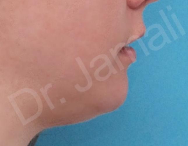 Chin Augmentation after