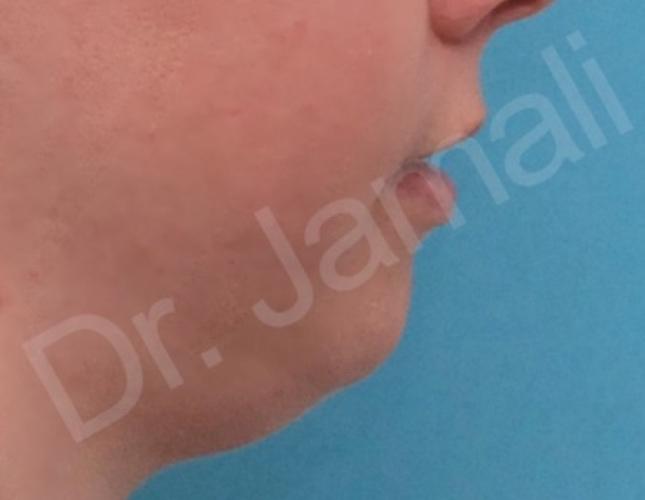 Chin Augmentation before