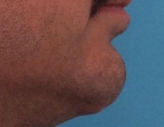 Implant Removal before