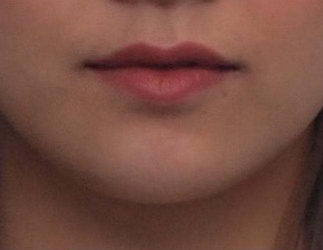 Chin Lengthening 6 after