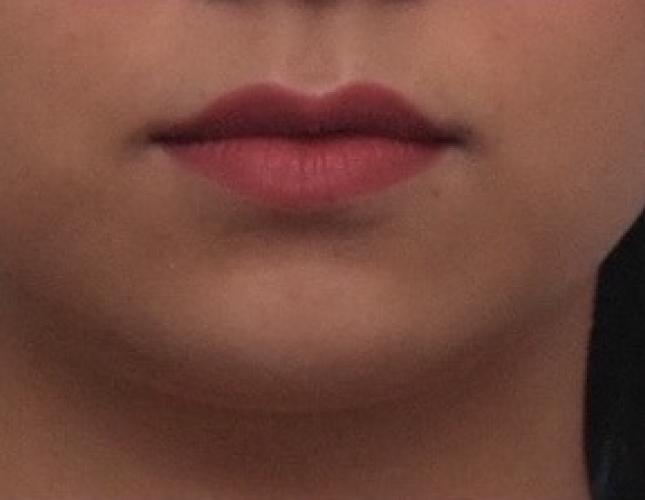 Chin Lengthening 6 before