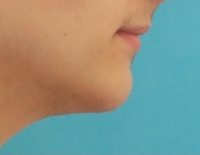 Chin Lengthening 2 after