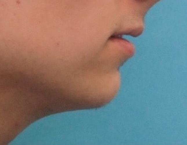 Chin Lengthening 2 before