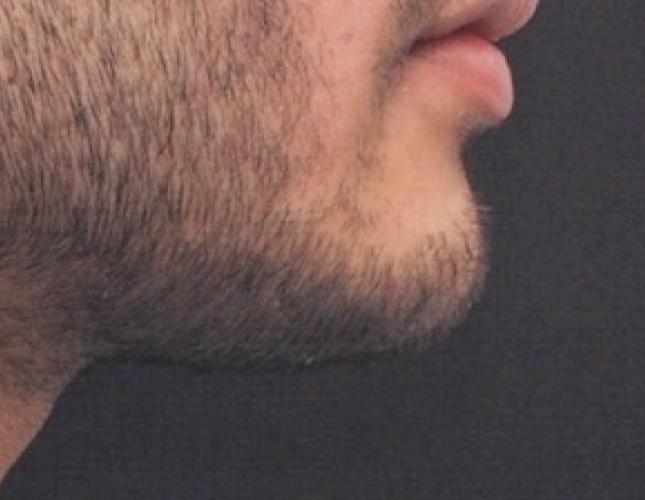 Chin Lengthening 3 after