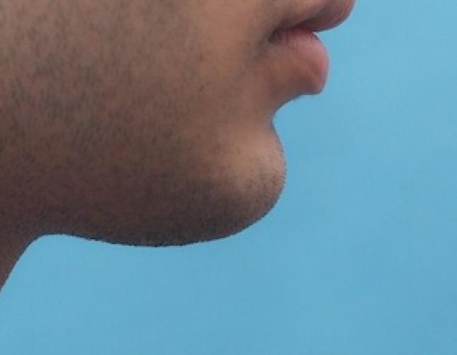 Chin Lengthening 3 before