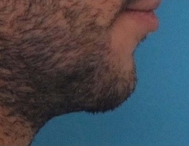 Chin Lengthening 4 after