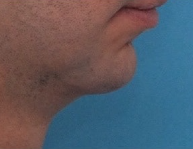 Chin Lengthening 4 before