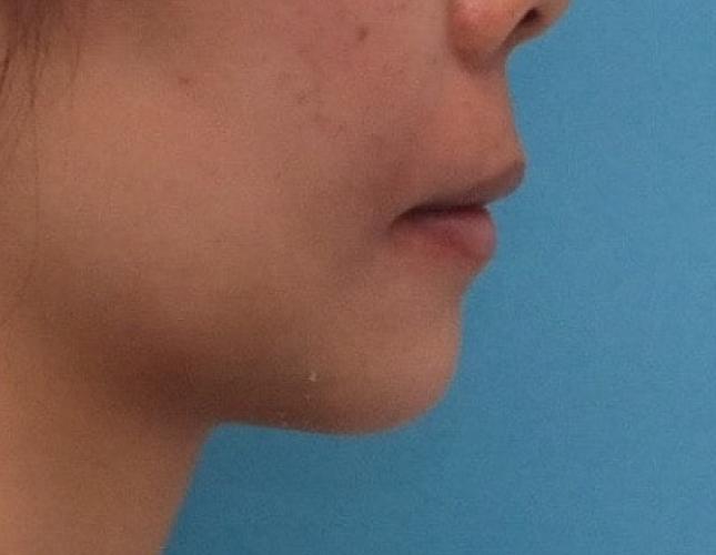 Chin Lengthening 5 side after