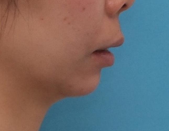 Chin Lengthening 5 side before