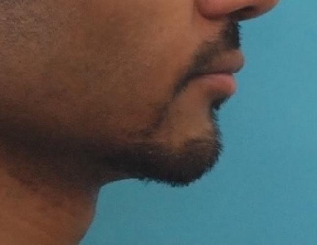 Chin Lengthening 1 after