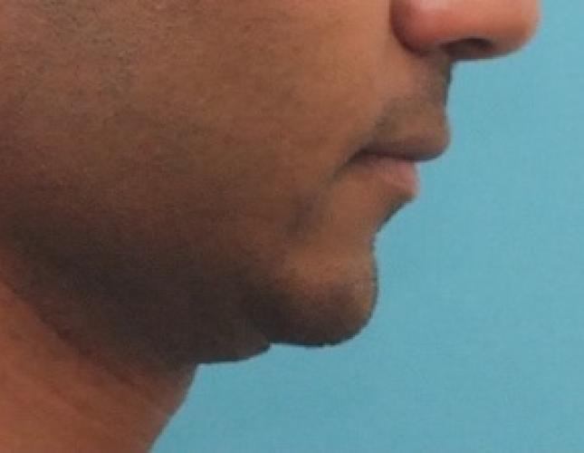 Chin Lengthening 1 before