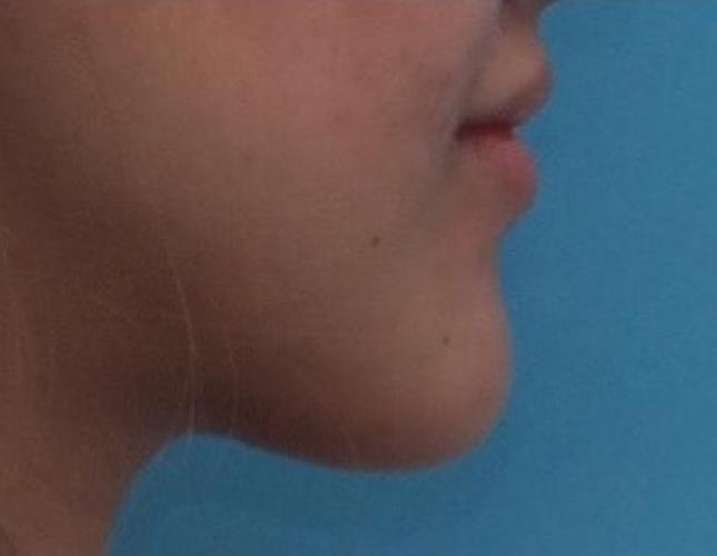 Chin Shortening before
