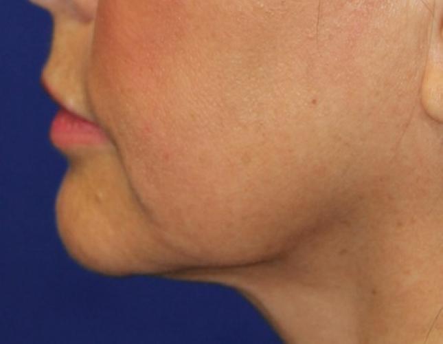 FaceTite 10 after