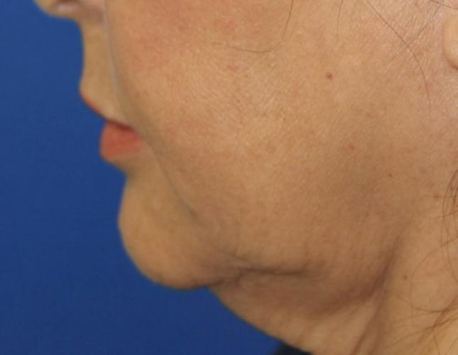 FaceTite 10 before