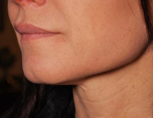 FaceTite 11 after