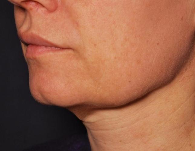 FaceTite 11 before