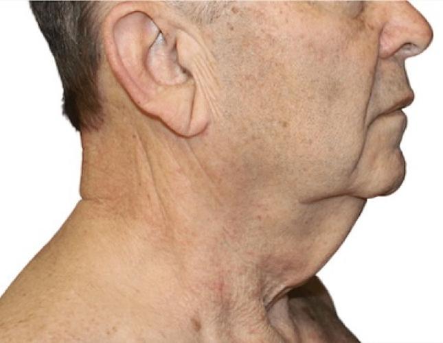 FaceTite 15 before