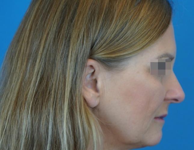Facetite 3 after