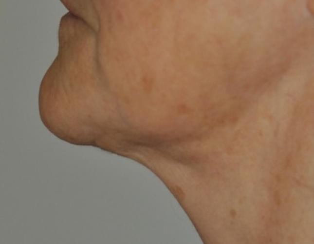 Facetite 4 after
