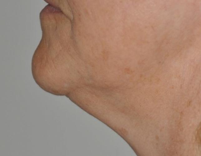 Facetite 4 before