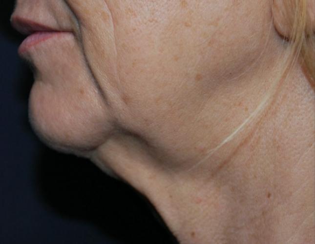 Facetite 5 before