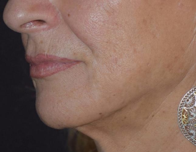 Facetite 6 after