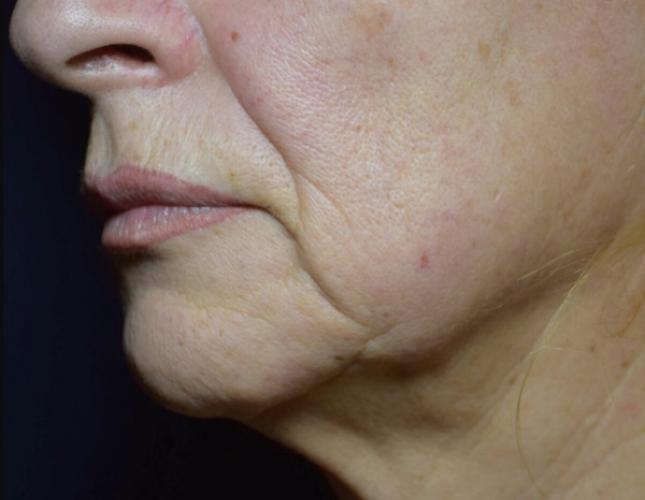 Facetite 6 before